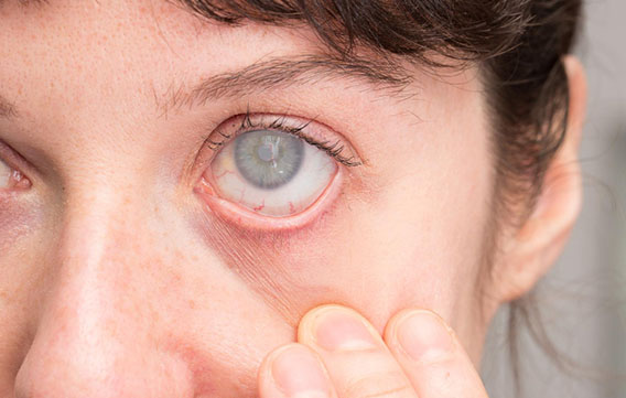 Glaucoma Services
